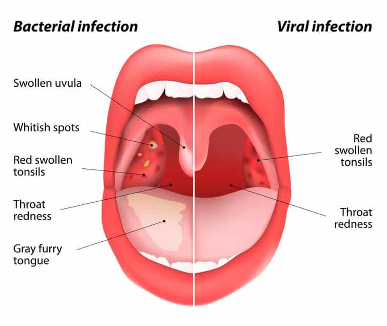 what are symptoms of strep throat