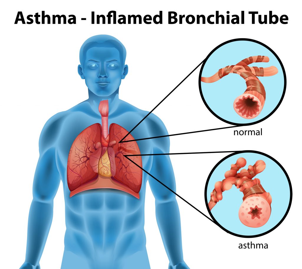 Can Essential Oils be Used for Asthma Treatment? Essential Oil Benefits
