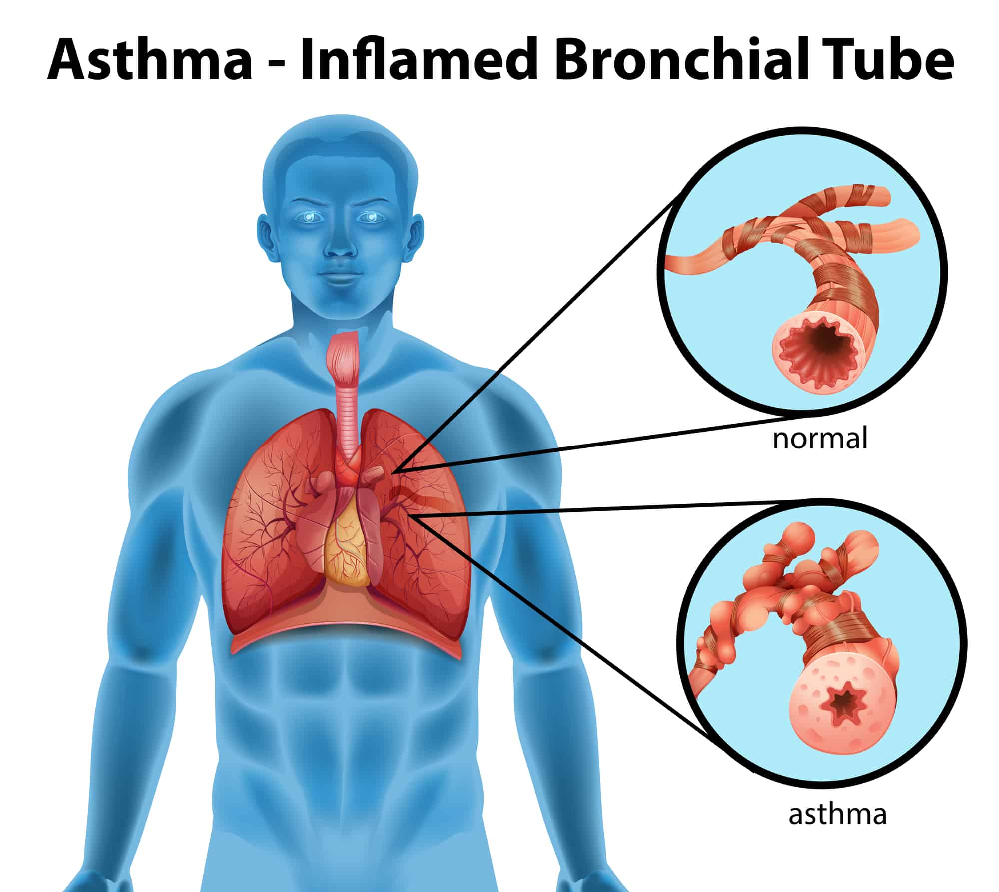 nocturnal asthma symptoms in adults