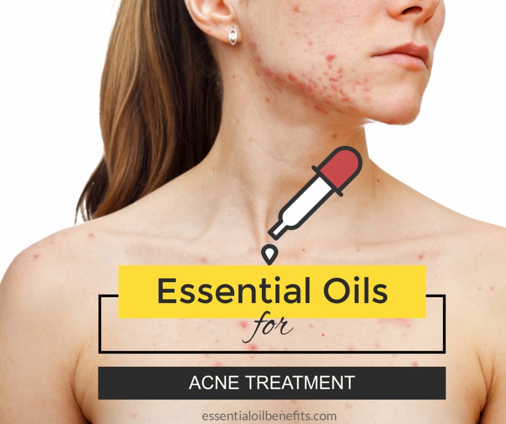 Best Essential Oils & Recipes For Acne Treatment Essential Oil Benefits