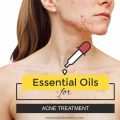 Essential oils for acne treatment