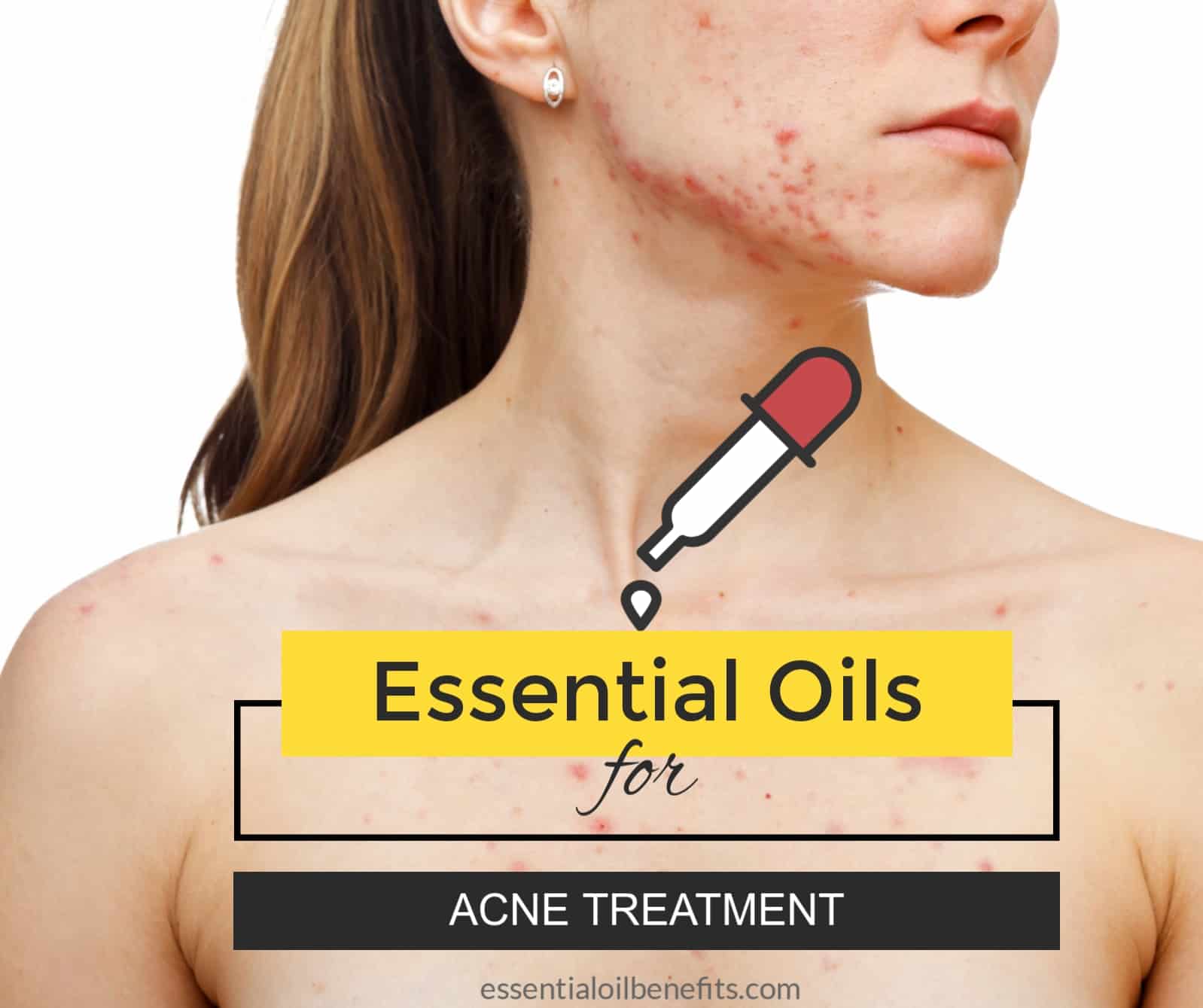 Essential oils for acne treatment