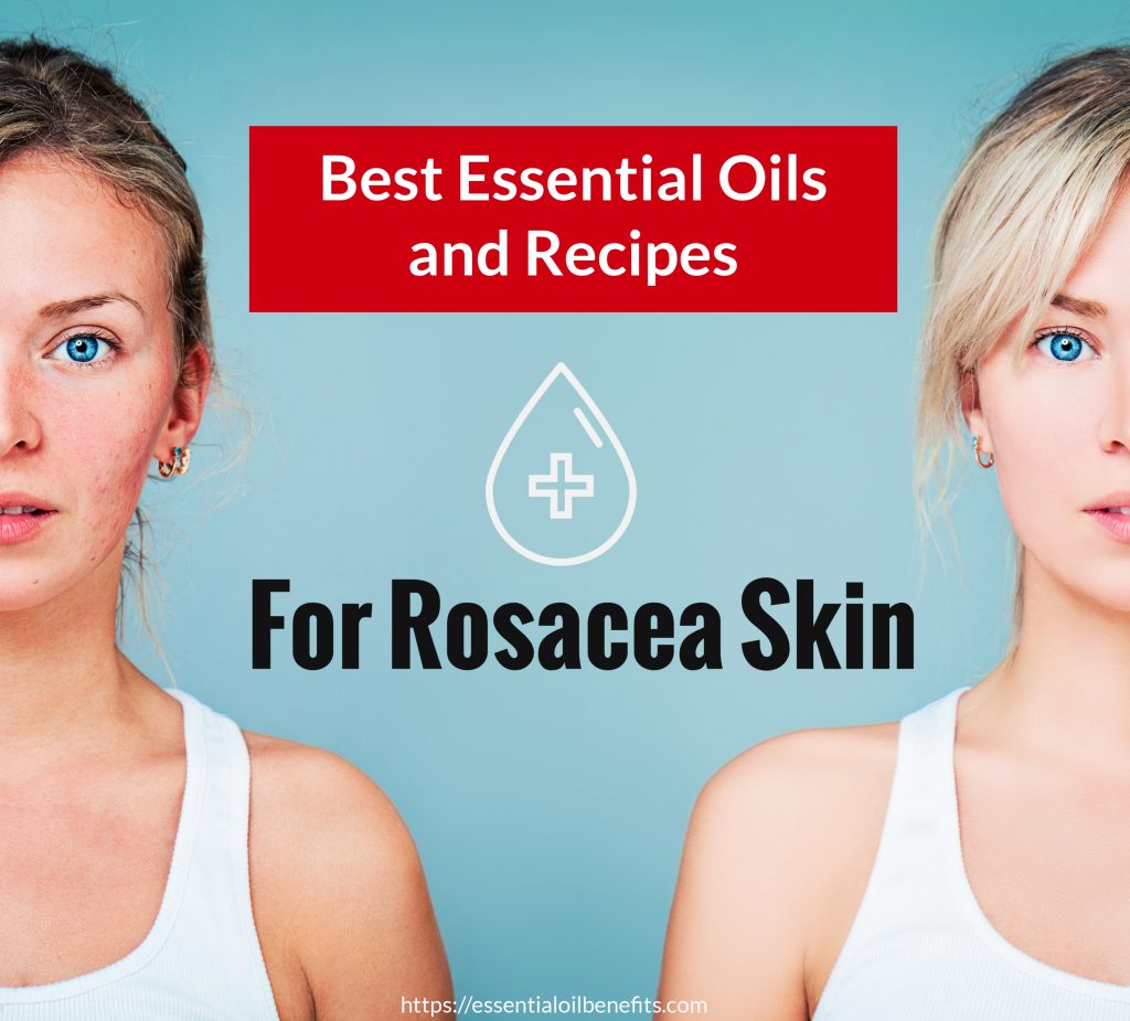 The Best Essential Oils And Essential Oil Recipes For Rosacea Skin Revealed Essential Oil Benefits