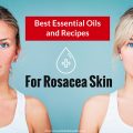 essential oils for rosacea