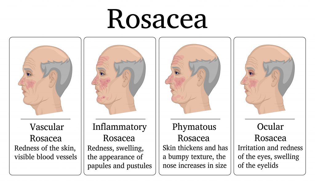 Best Essential Oil And Recipes For Rosacea Skin Essential Oil Benefits