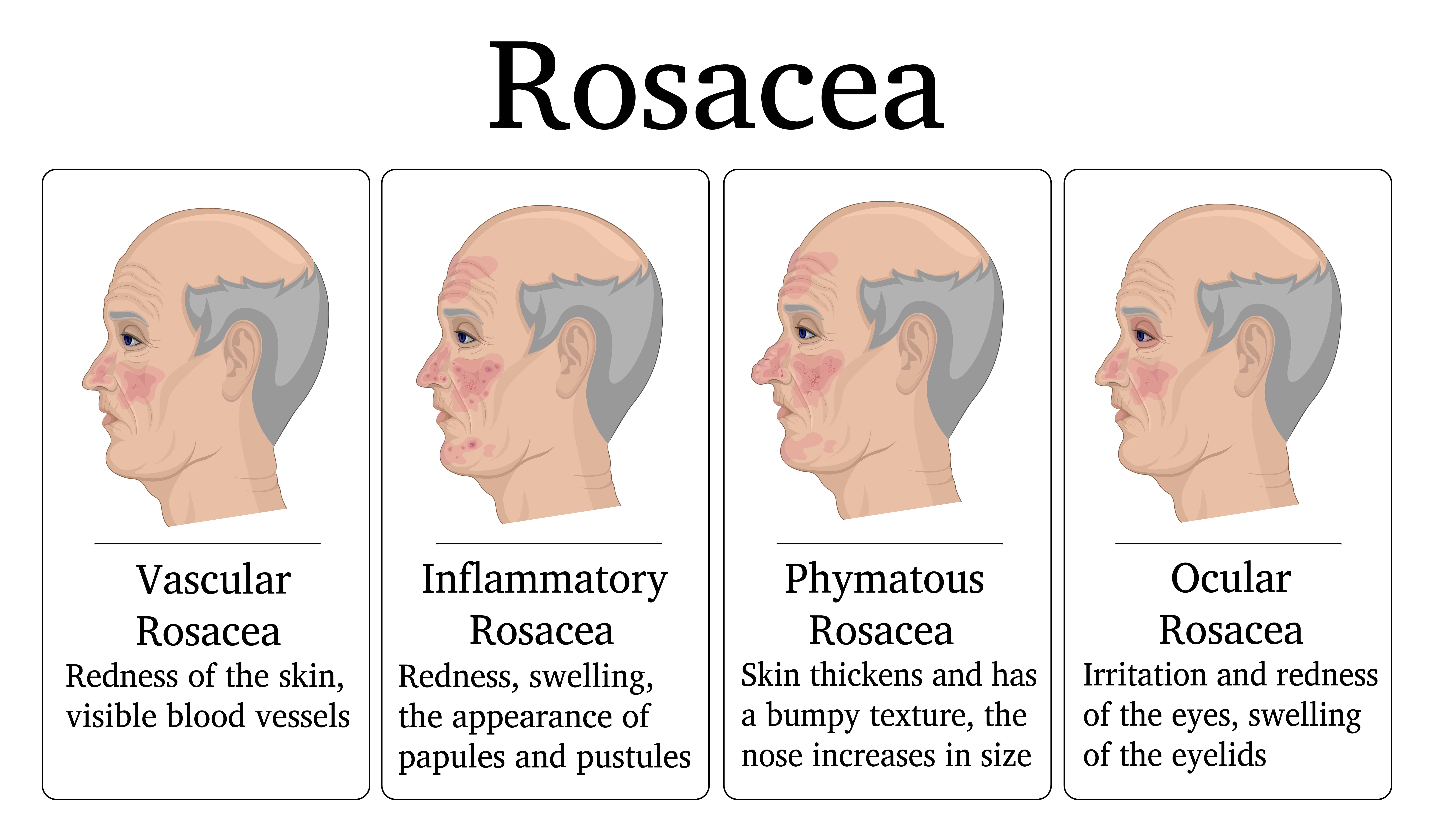 The Best Essential Oils And Essential Oil Recipes For Rosacea Skin Revealed Essential Oil Benefits