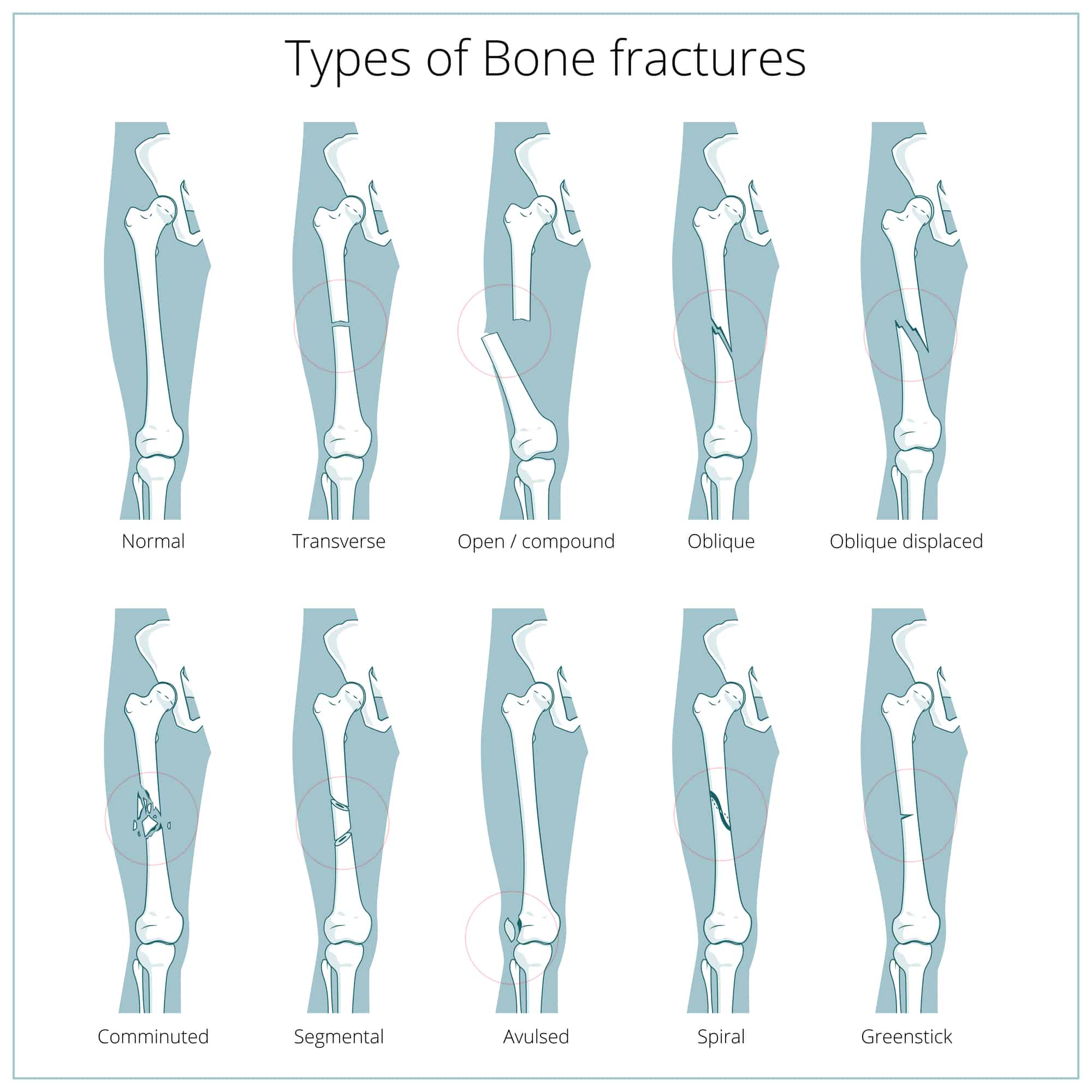 Types of bone fracture serviceseka