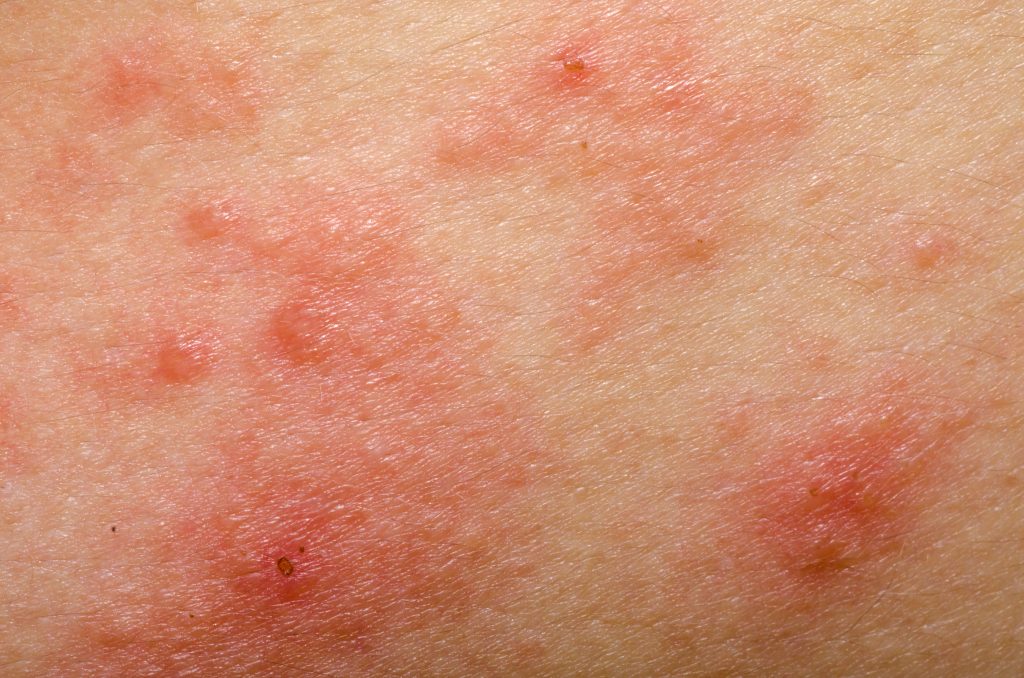 What Are The Best Essential Oils And Recipes For Quick Relief Of Eczema? Essential Oil Benefits
