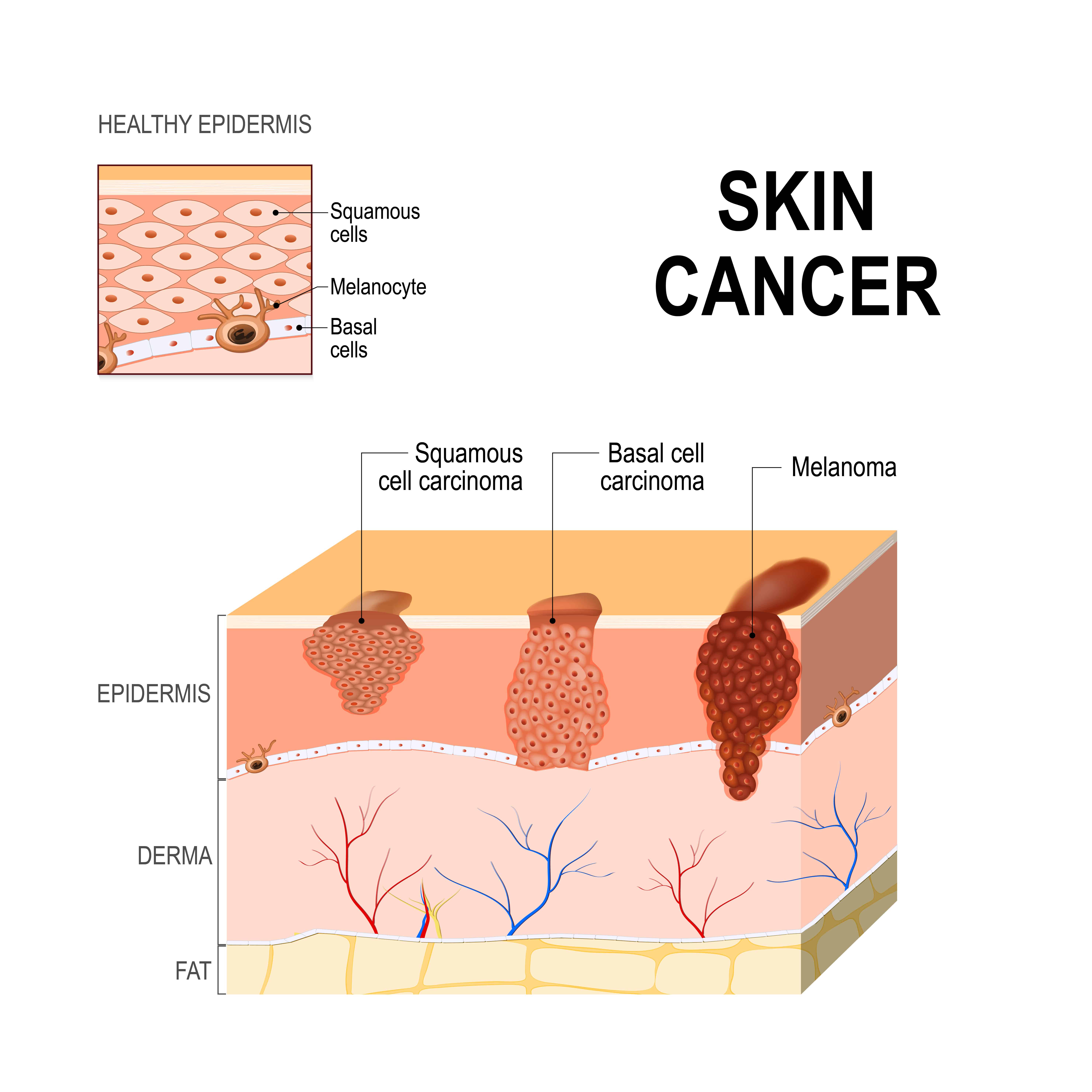 What Are The Best Essential Oils And Recipes For Skin Cancer? Essential Oil Benefits