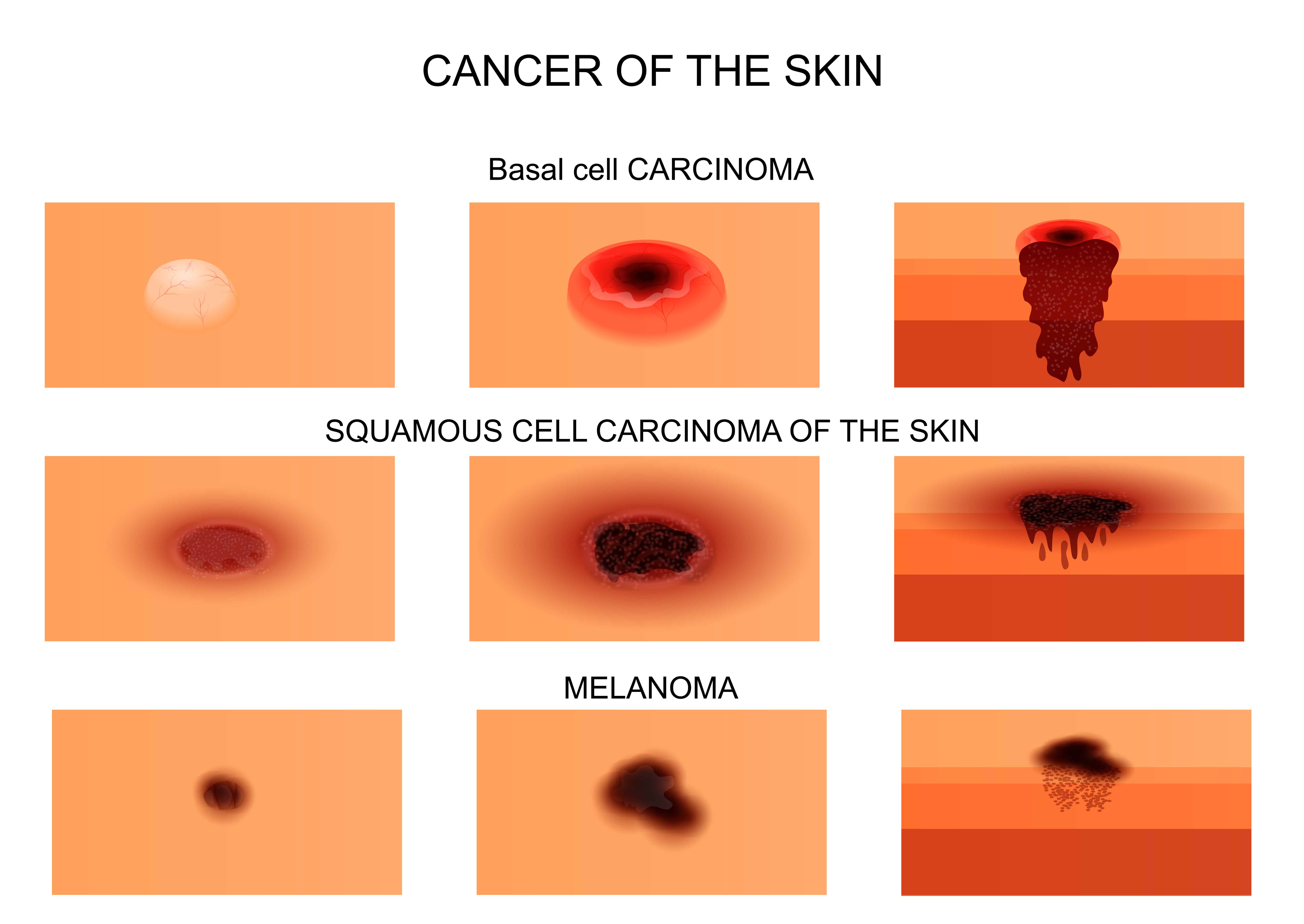 What Are The Best Essential Oils And Recipes For Skin Cancer? Essential Oil Benefits
