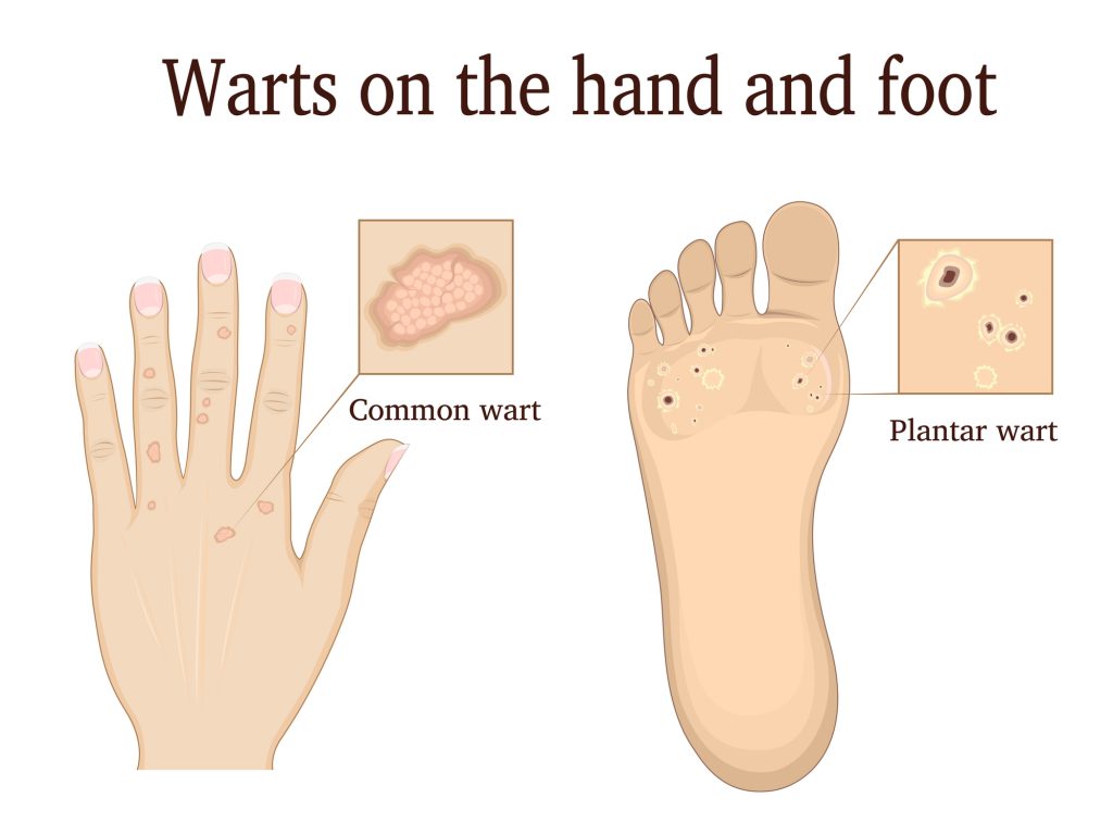 How To Use Essential Oils For The Best Possible Elimination Of Warts? Essential Oil Benefits