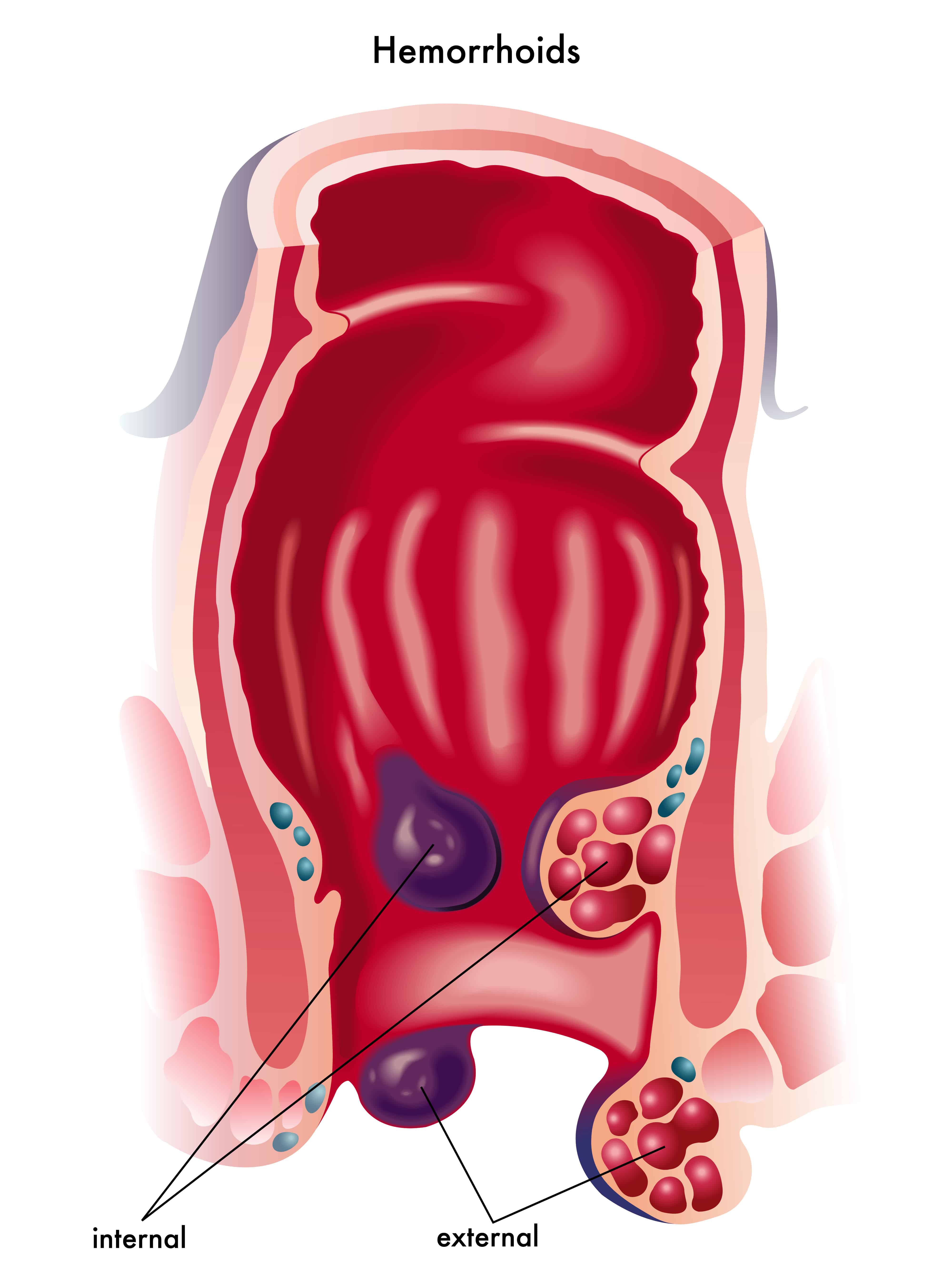 Can Internal Hemorrhoids Cause Stomach Ache