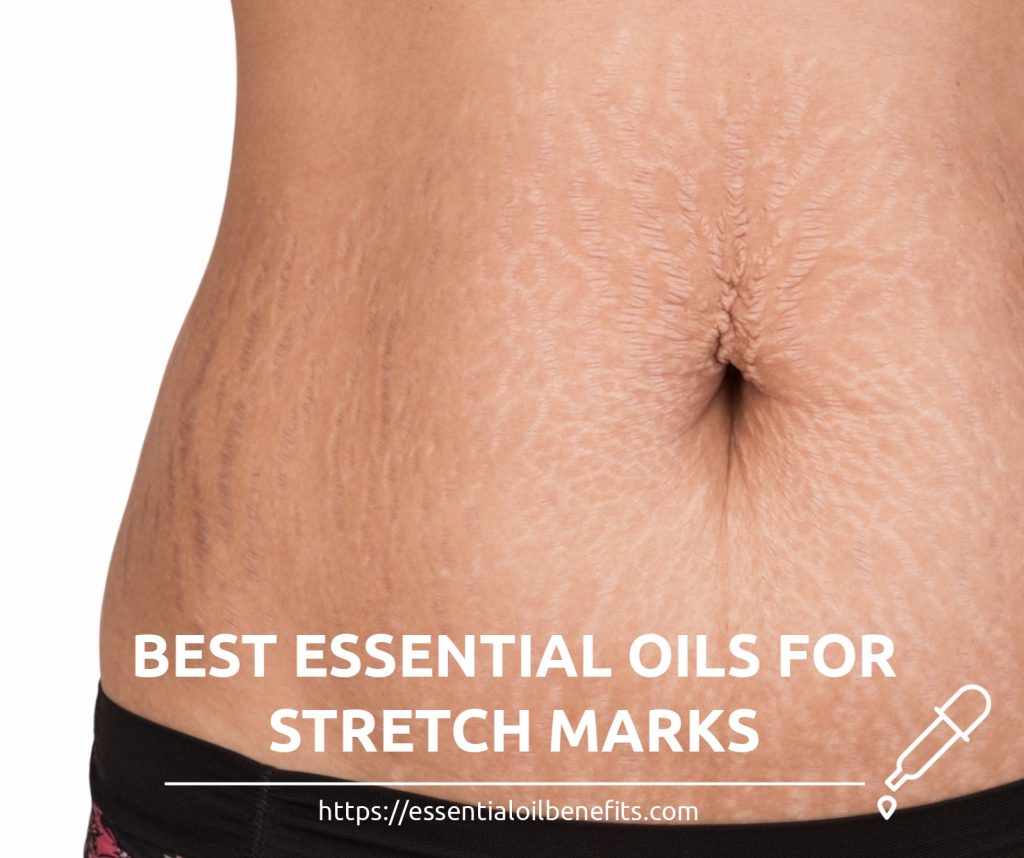 How To Get Rid Of Stretch Marks Using Essential Oils? Essential Oil Benefits