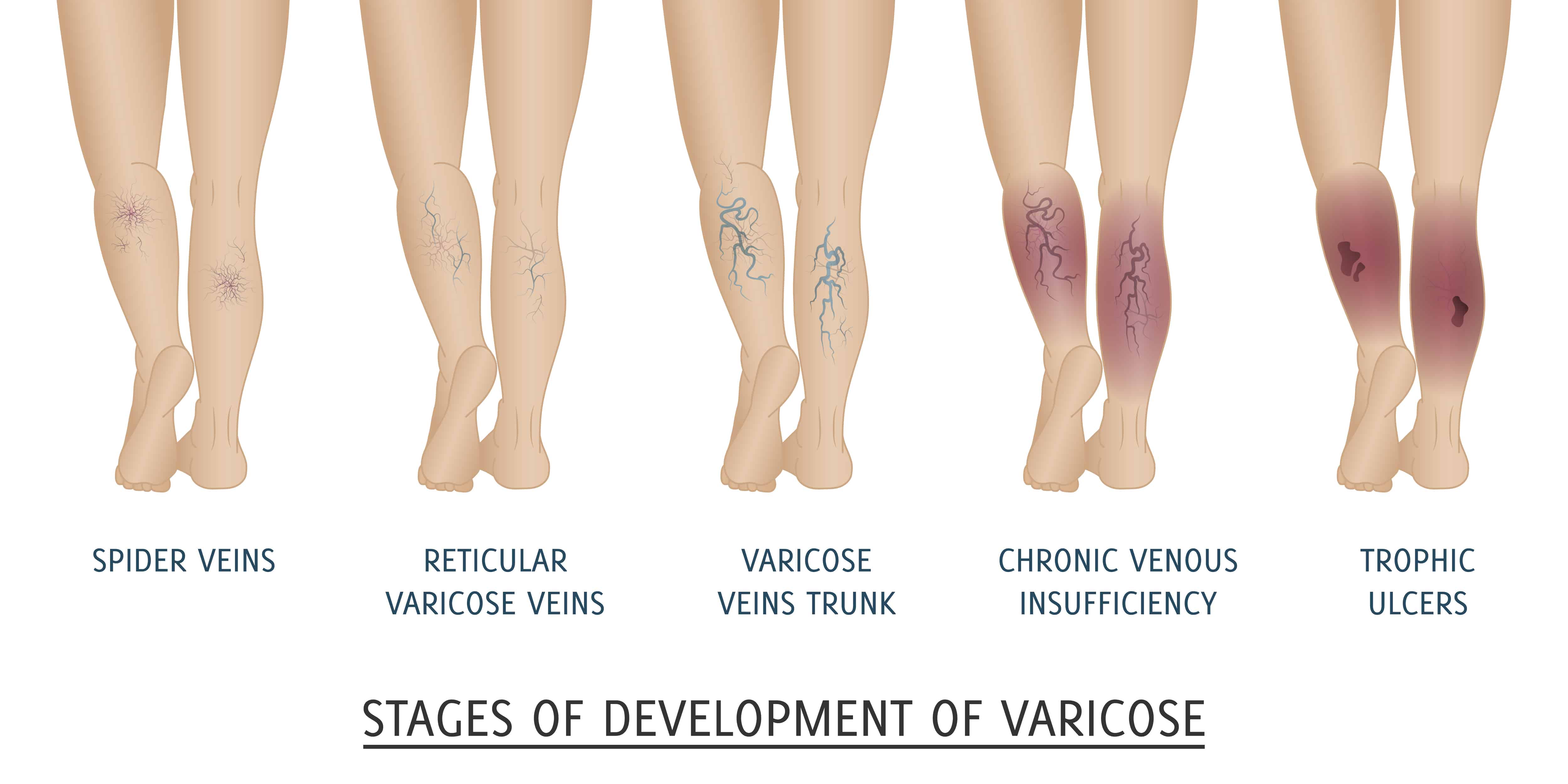 Varicose Vein Size Chart