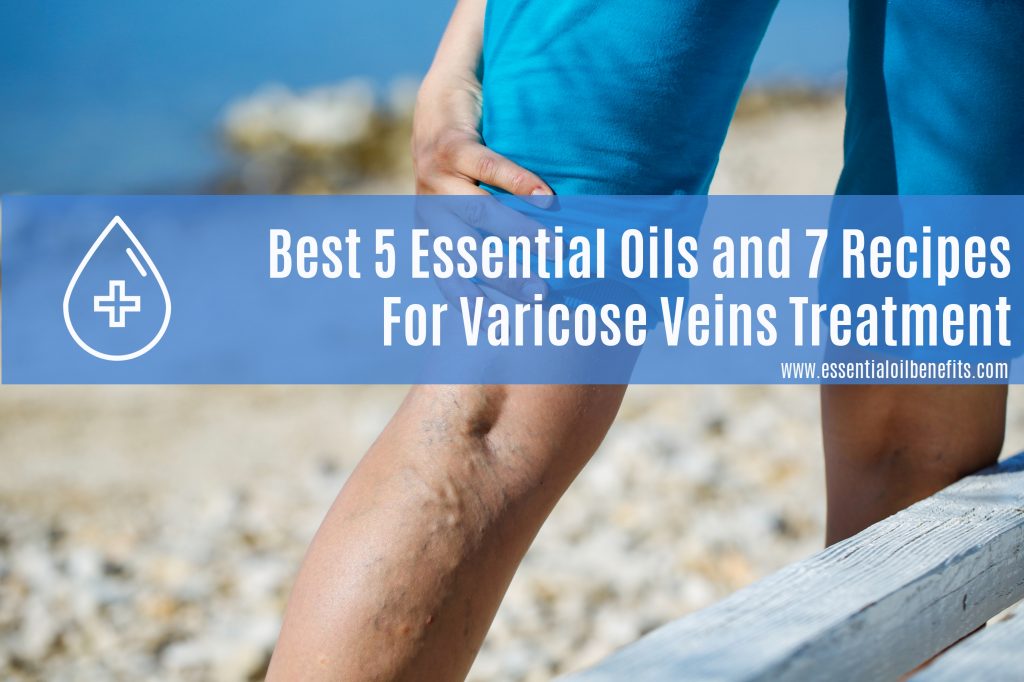 Best Essential Oils and Recipes For Varicose Veins Treatment