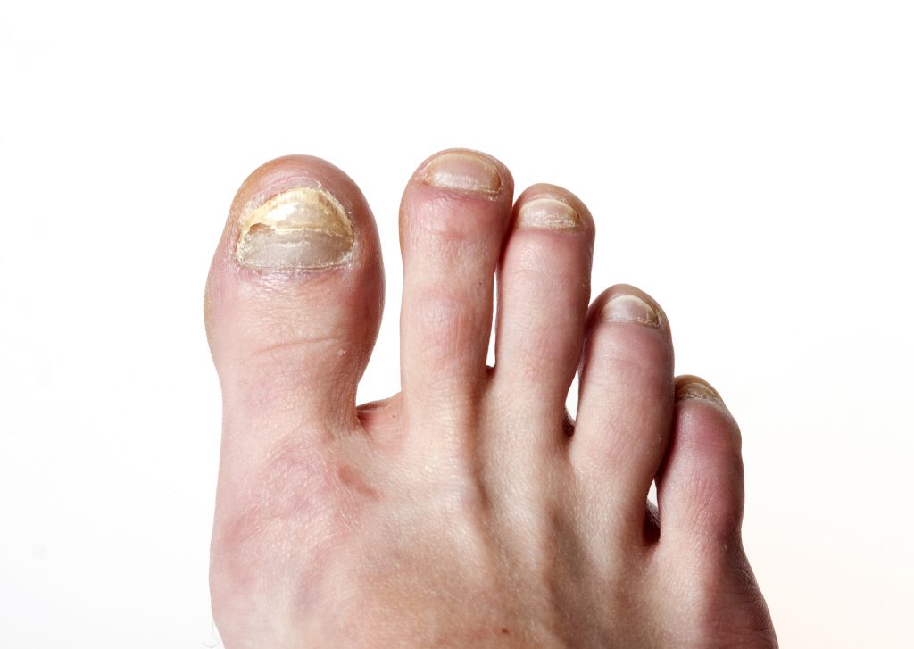 Best Essential Oils For Nail And Toenail Fungus Essential Oil Benefits