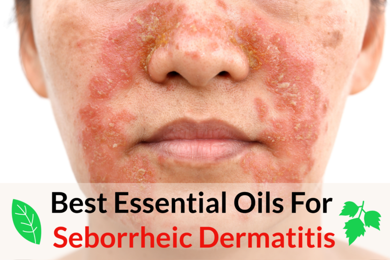 12 Essential Oils For Seborrheic Dermatitis Essential Oil Benefits