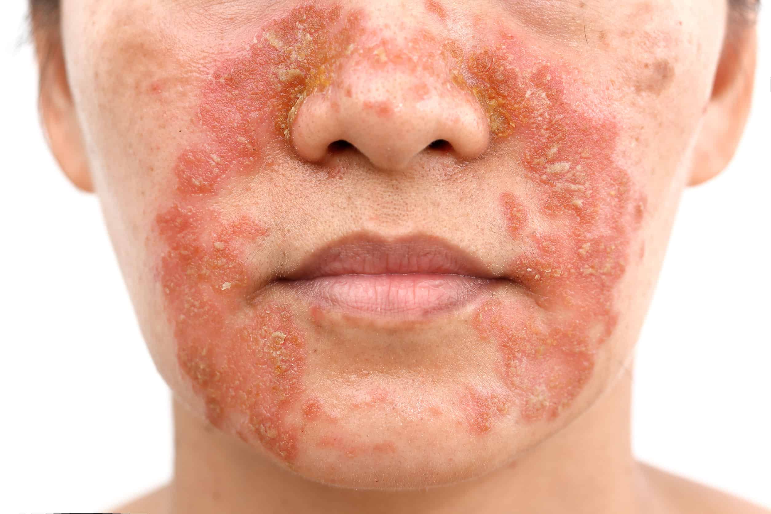 Seborrheic Dermatitis face