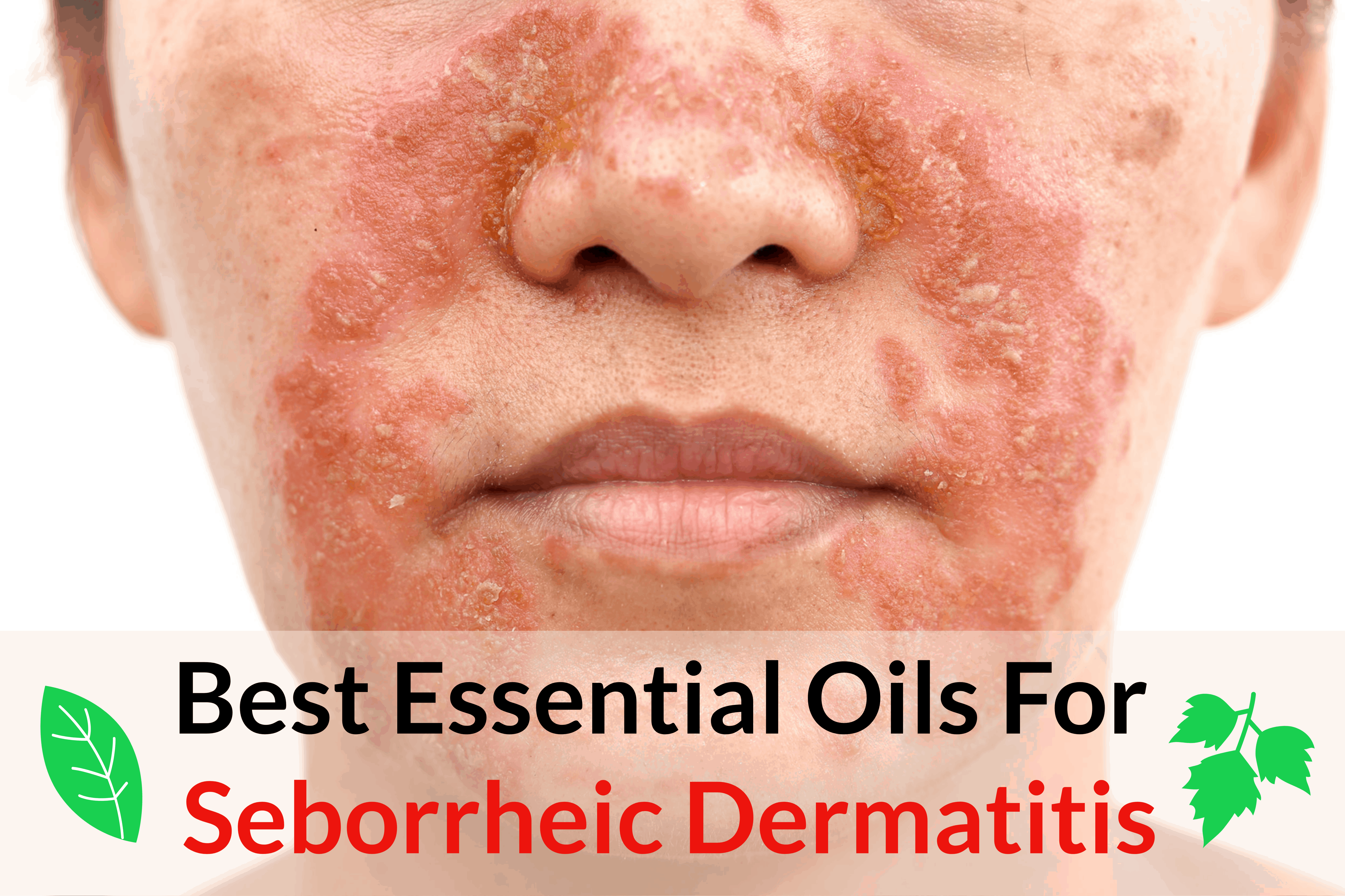 12-essential-oils-for-seborrheic-dermatitis-essential-oil-benefits