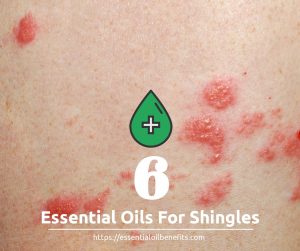 6 Best Essential Oils Recipes Shingles and PHN Symptoms | Essential Oil ...