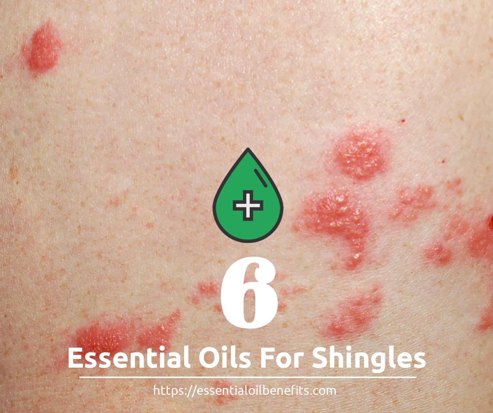 essential oils for shingles