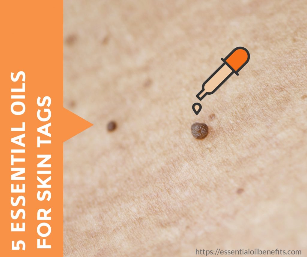 Best Essential Oils To Use For Skin Tags Removal Essential Oil Benefits
