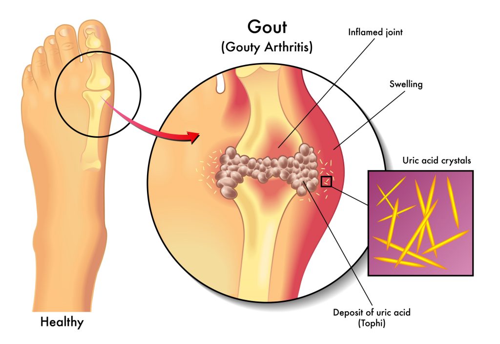 How To Use Essential Oils For Immediate Gout Relief Essential Oil Benefits