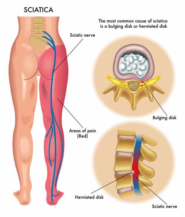 Are Essential Oils A Proven Treatment & Offer A Long Lasting Solution To Sciatica Pain? Essential Oil Benefits