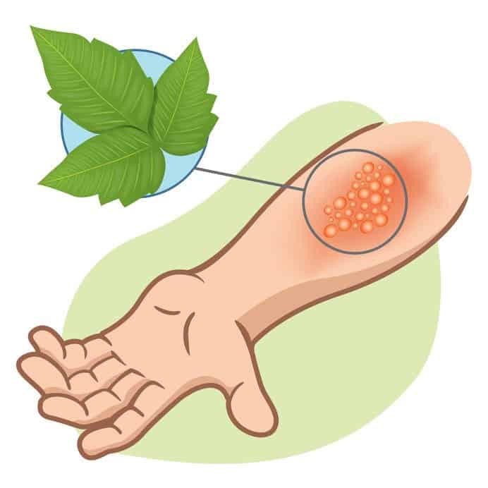 How To Use Essential Oils To Get Rid Of Poison Ivy: 7 Essential Oils & Recipes and 5 Home Remedies Essential Oil Benefits