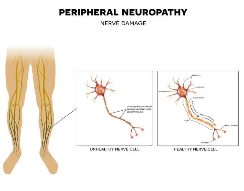 Essential Oils For Neuropathy: Everything You Need To Know For Neuropathic Pain Treatment Essential Oil Benefits