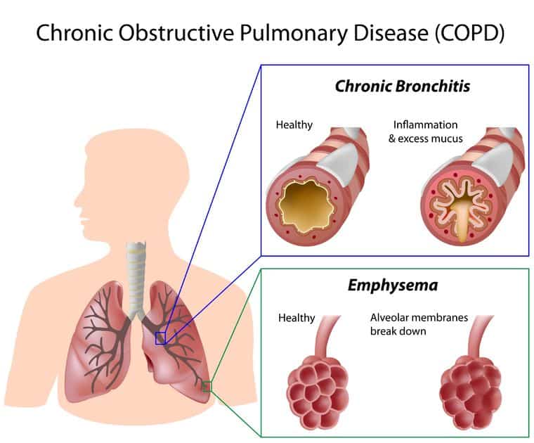 Essential Oils For COPD: Dealing With The Worst Group Of Lung Diseases Known To Man Essential Oil Benefits