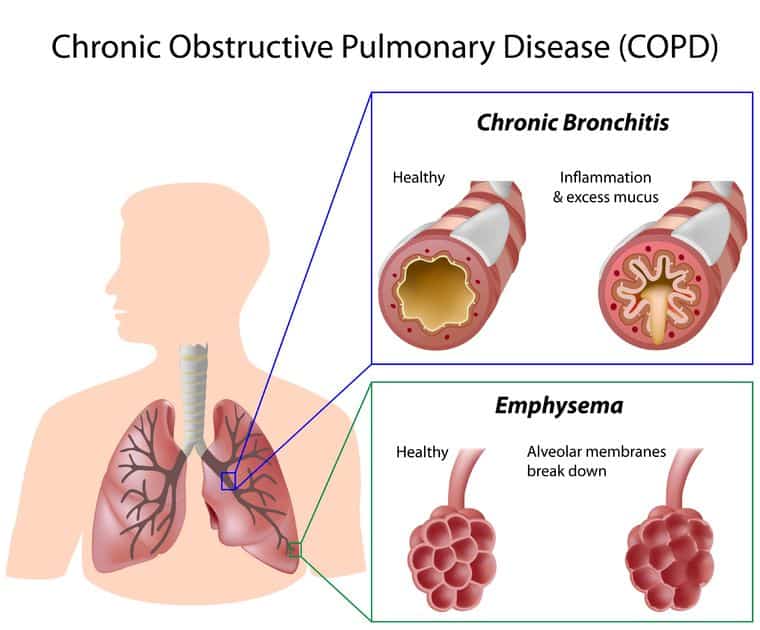 essential-oils-for-copd-dealing-with-the-worst-group-of-lung-diseases