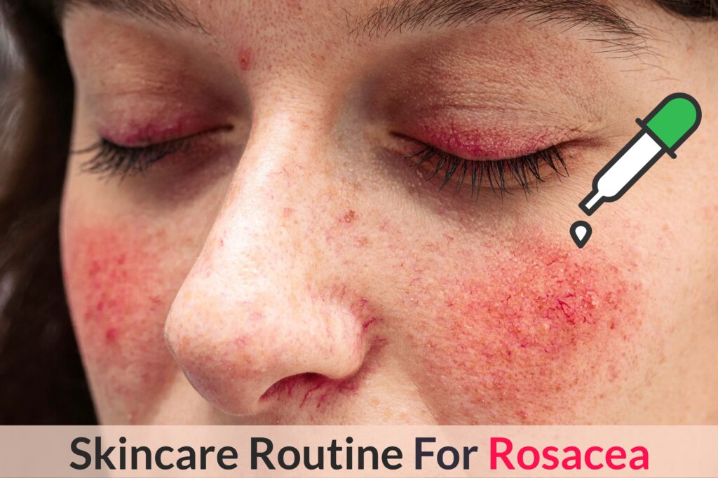 Want To Keep Your Rosacea Redness, Dryness And Inflammation Under Control? Try This Skincare Routine! Essential Oil Benefits