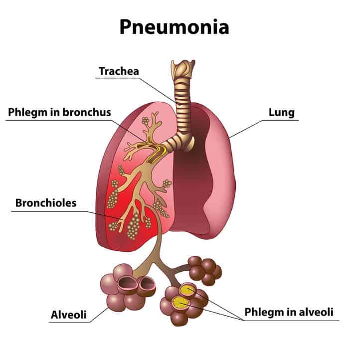 Essential Oils For Pneumonia: For When You Really Need A Sigh Of Relief Essential Oil Benefits