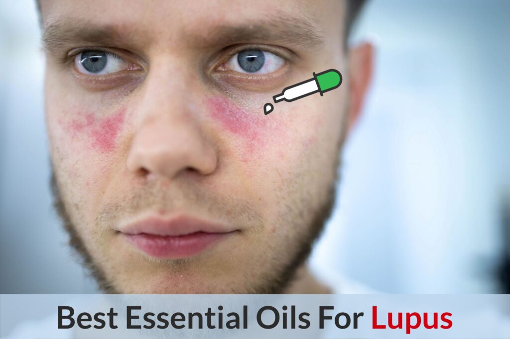Essential Oils For Lupus: For When your Body Wages War Against Itself Essential Oil Benefits