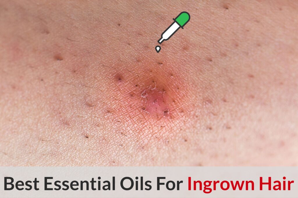 How To Use Essential Oils To Prevent And Treat Ingrown Hair Essential Oil Benefits