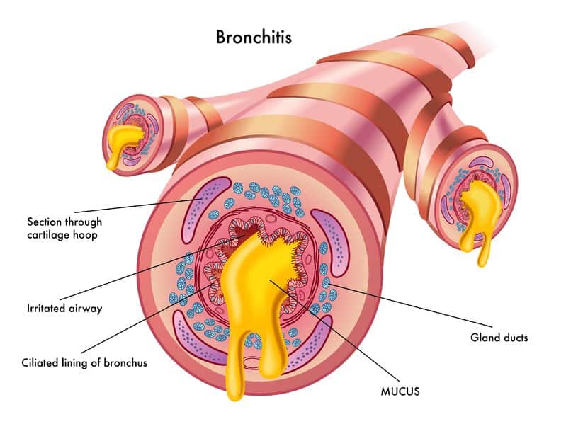 Essential Oils For Bronchitis: Dealing With Clogged Up Vents And Inflamed Chimneys Essential Oil Benefits