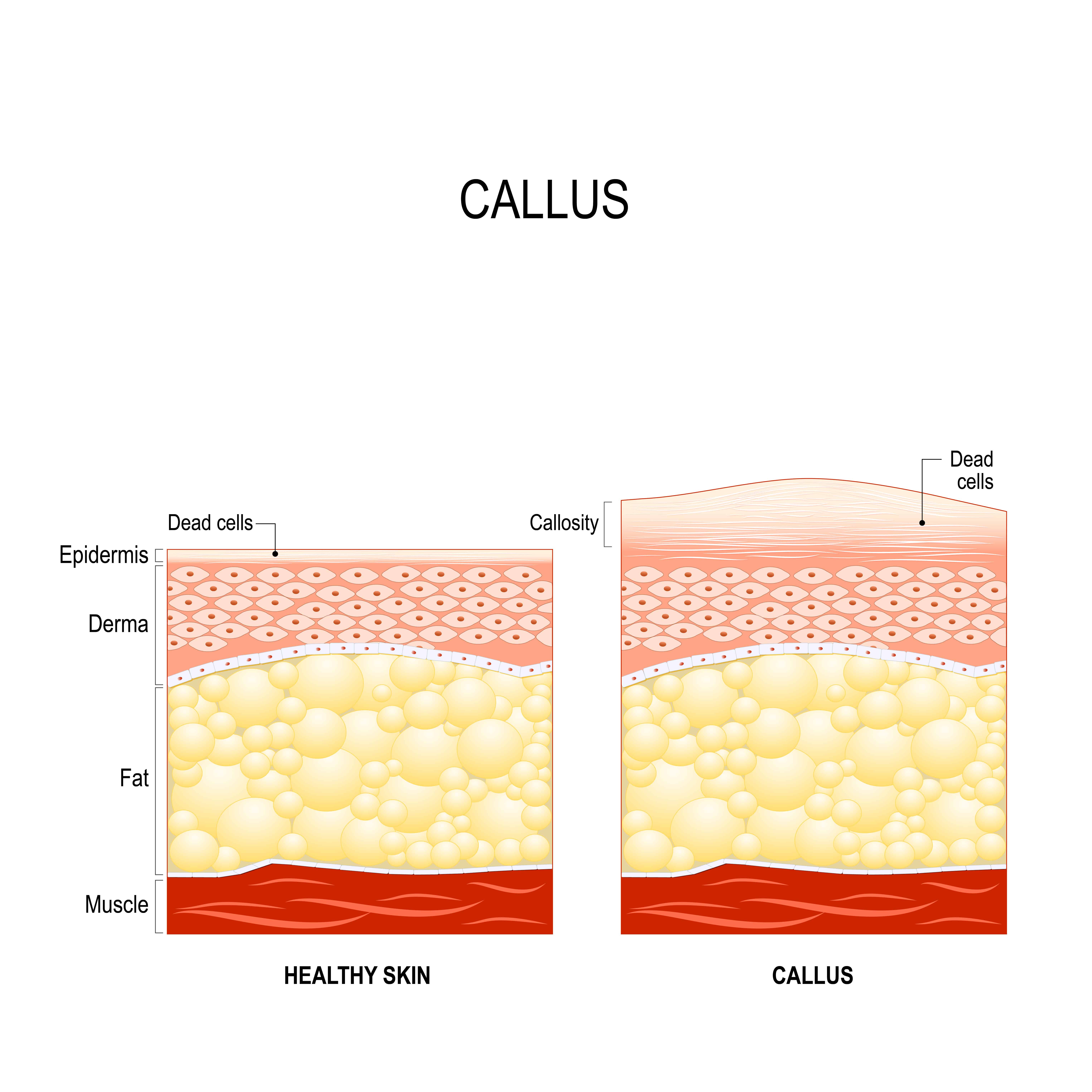 Essential Oils For Calluses: When You’re Tired Of Corns, Blisters, And Calluses Essential Oil Benefits