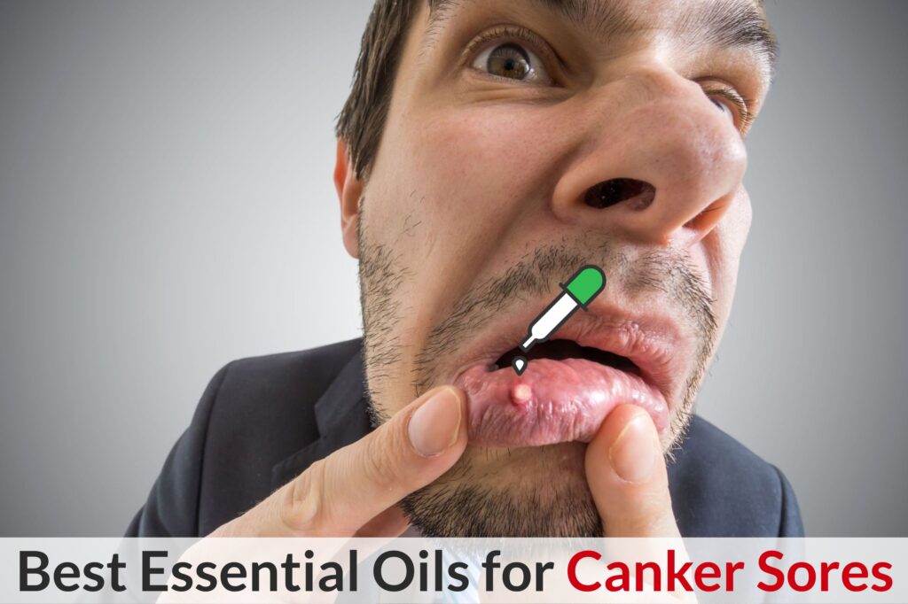 Don’t Let Those Canker Sores Get You Cranky! Let Essential Oils Deal With Them! Essential Oil Benefits