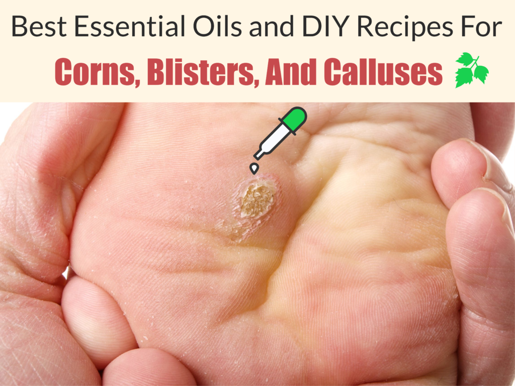 Essential Oils For Calluses: When You’re Tired Of Corns, Blisters, And Calluses Essential Oil Benefits