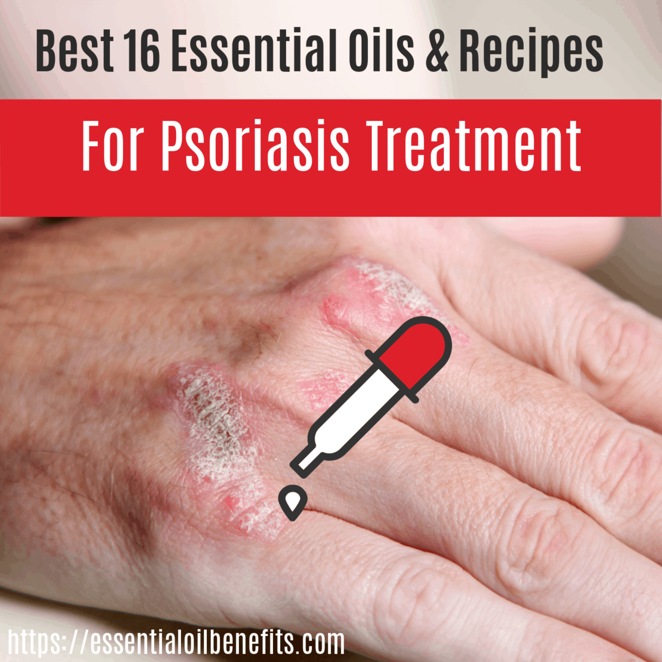 What Are The Best Essential Oils for Psoriasis And What Is The Best Psoriasis Essential Oil Recipe? Essential Oil Benefits