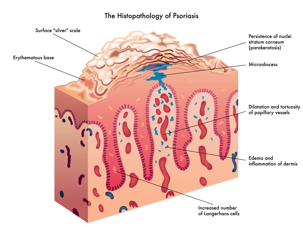 What Are The Best Essential Oils for Psoriasis And What Is The Best Psoriasis Essential Oil Recipe? Essential Oil Benefits