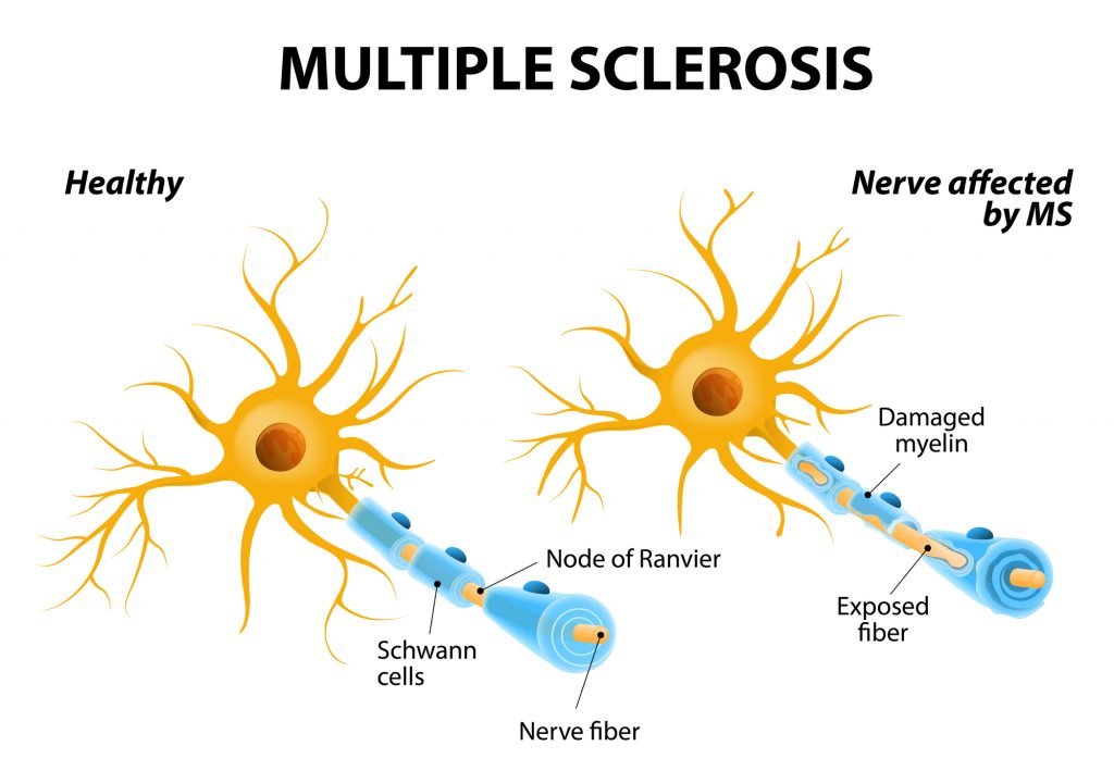 Essential Oils For Multiple Sclerosis: Beating MS One Step At A Time Essential Oil Benefits