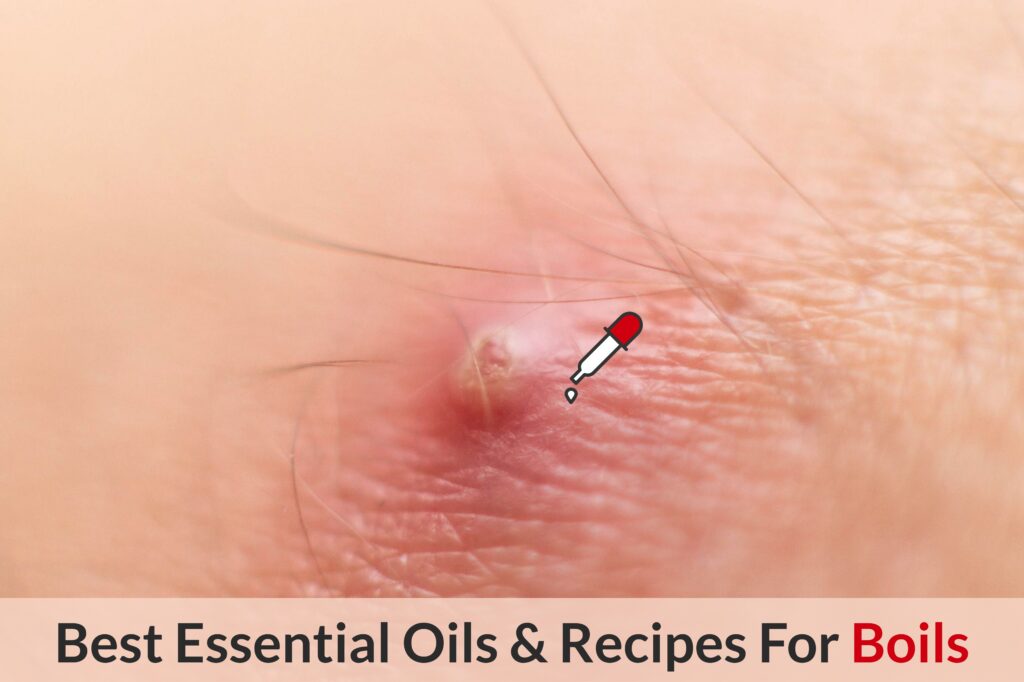 Essential Oils For Boils: Your Ultimate Guide To Treating And Preventing Boils! Essential Oil Benefits