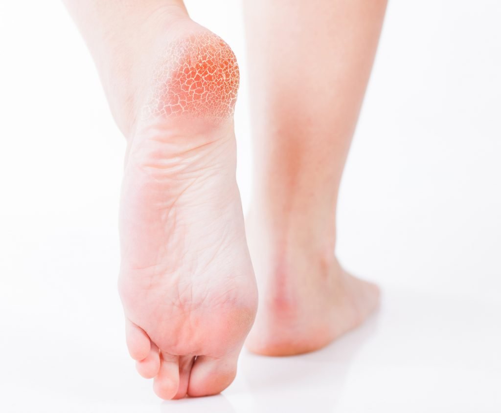 Essential Oils For Cracked Heels: When Achilles Got Nothing On You Essential Oil Benefits