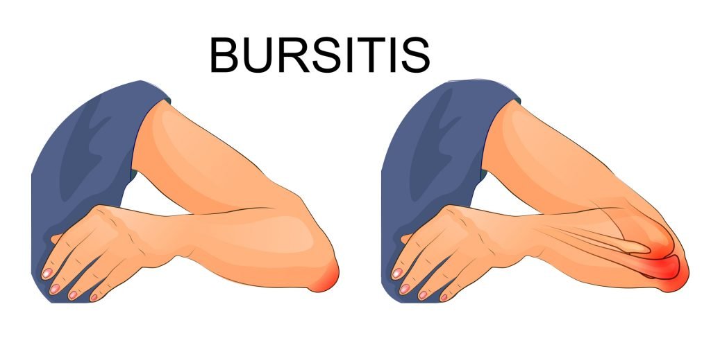 Best Essential Oils And Home Remedies To Stop Bursitis From Bringing Pain Into Your Life! Essential Oil Benefits