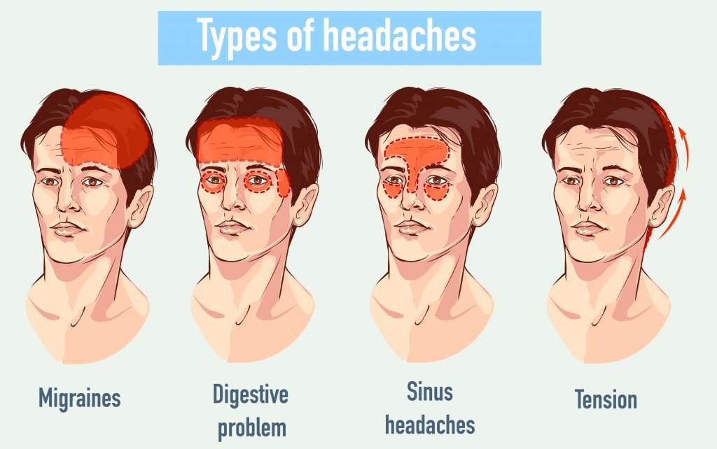 Sinus Headache Location Chart