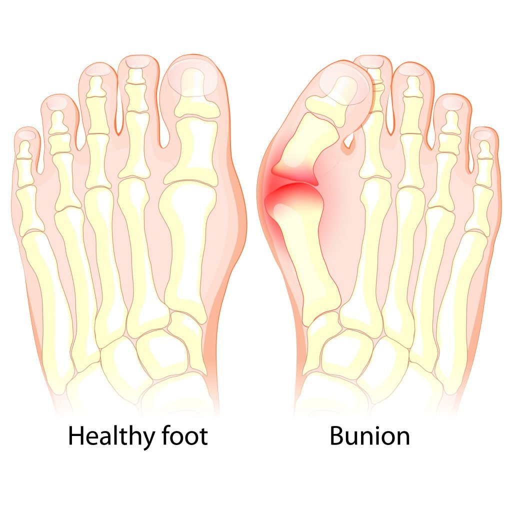 Can Essential Oils Help To Heal Bunions? Essential Oil Benefits