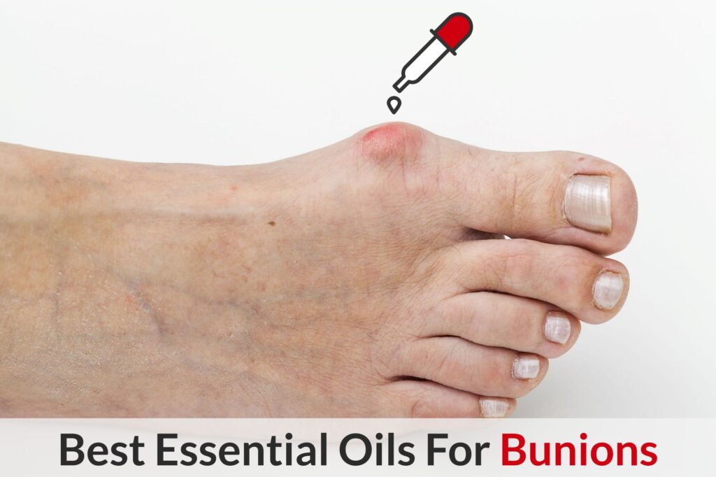Can Essential Oils Help To Heal Bunions? Essential Oil Benefits