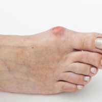 Best Essential Oils for Bunions